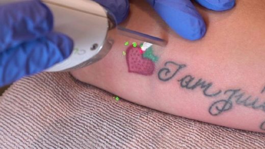 laserowe usuwanie tatuaży